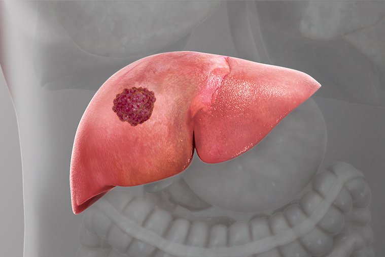 Liver Cancer Treatment